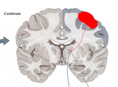 What are the implications of a unilateral lesion in the somatosensory I cortex as shown in the picture?