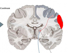What are the implications of a unilateral lesion in the somatosensory I cortex as shown in the picture?
