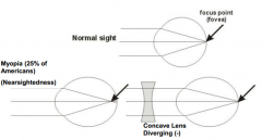 Myopia - light from far away focuses in front of the fovea (eye is too long or cornea too strong)
- Use concave lens (diverging -)