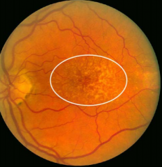 Are-related Macular Degeneration (AMD)