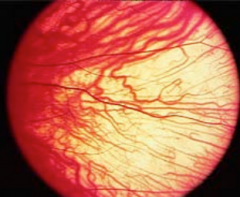 Macular Translucency - clinical sign of albinism