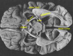- Damage to Myer's Loop (leads to restricted visual field defect)
- Used to relieve temporal lobe epilepsy
