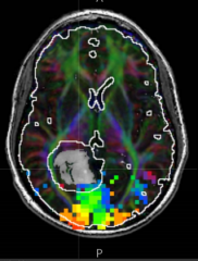 What do the colors represent on this fMRI?