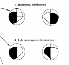 Loss of vision in a hemifield