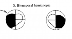- Non-corresponding loss in each eye
- A loss of vision in either both nasal halves (binasal hemianopia) or both temporal halves of the visual field (bitemporal hemianopia)