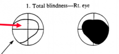 Total Blindness in right eye