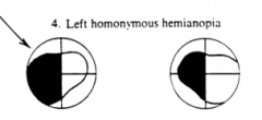 Left Homonymous Hemianopia