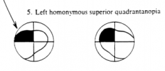 L Homonymous Superior Quadrantanopia