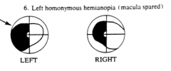 Left Homonymous Hemianopia (macula spared?)