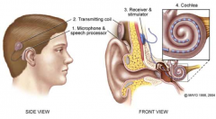 - Hearing aids - amplify sounds of specific frequencies (may not be enough)
- Cochlear implants (in picture)
