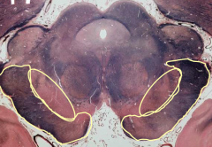 Cerebral Peduncle - Rostral Midbrain