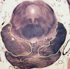 Crus Cerebri - Caudal Midbrain