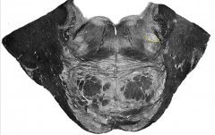 Facial Nucleus - Pons (Caudal)