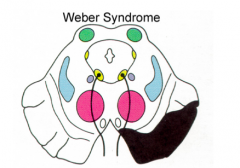 - Corticospinal tract --> contralateral paralysis of lower face, tongue, arm, and leg
- CN III --> ipsilateral oculomotor palsy (eyes deviate laterally, ptosis, pupil is dilated and fixed)
* Weber Syndrome * 
- Occlusion of PCA