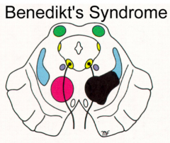 Unilateral lesion of red nucleus = Benedikt's syndrome