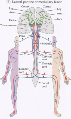 - Lateral Medullary Syndrome
- Face - ipsilateral
- Body - contralateral