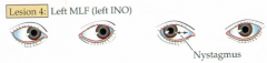 What is the explanation for the symptoms of an Internuclear Ophthalmopolegia (INO)?