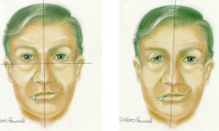 - Bell's: 1/2 of forehead can wrinkle - entire half of face cannot move (LMN lesion) - R picture
- Corticonuclear Tract Lesion: all of forehead can wrinkle - only 1/4 of face cannot move (UMN lesion) - L picture