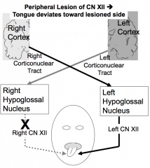 Tongue deviates toward side of lesion