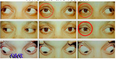 Impaired R eye adduction  --> R Internuclear Ophthalmoplegia --> R Medial Longitudinal Fasciculus (MLF) lesioned