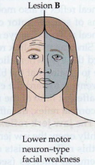 - CN VII lesion
- Ipsilateral upper and lower facial weakness
- Bell's Palsy