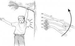 - Opposite of Erb's
- Weakness in fingers, but no difficulty moving across shoulder and elbow
- Can be caused when hanging from tree
* Lesion of lower trunk of brachial plexus *