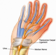 - Median nerve compression at wrist (neuropathy)
- Caused by overuse of finger flexors from repetitive tasks cause these muscles to hypertrophy
- Hypertrophied muscles and median nerve pass through tunnel, which is a confined space
- Muscles compress n