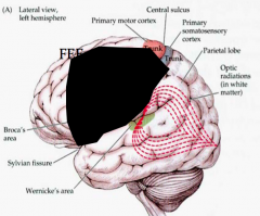 L frontal cortex and parietal cortex
(MCA distribution)
- Stroke

- Broca’s aphasia --> L frontal cortexcortical sign
- L gaze preference --> R FEF working --> L FEF lesioned --> cortical sign
- R lower face & arm --> L frontal cortex
- R arm/face