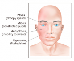 - Ptosis (drooping eyelid)
- Miosis (constriction of pupil)
- Anhidrosis (inability to sweat)
- Enophthalmos (posterior displacement of eyeball within orbit due to ptosis)
