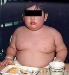 - Chromosomal deletion of 15q11-13
- Inherited from father
- Hypothalamic dysfunction includes hyperphagia (increased eating) --> obesity
- Also causes narcolepsy and short stature