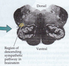 - Brainstem stroke (e.g., lateral medullary stroke)
- Sympathetic neurons
