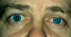 Horner's Syndrome (on L)
- Ipsilateral:
- Miosis - small pupil
- Ptosis - weakness of superior tarsal muscle (Müller's)
- Anhidrosis - decreased facial sweating