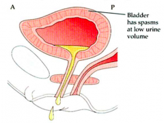 - Hyperactive bladder (detrusor)
- Underactive sphincter
- Due to lesions of sympathetics
- Treat with anti-cholinergics to relax bladder walls