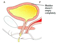 - Hypoactive bladder (detrusor)
- Overactive sphincter
- Due to lesions of parasympathetics
- Treat with anti-adrenergics to relax sphincter; self-catheterization
