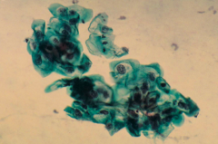 - Cytological evidence of displasia or neoplasia; detection of koilocytotic cells (vacuolated cytoplasm) which are rounded and appear in clumps
- Odd looking cells (easy to miss and easy to get false positive)