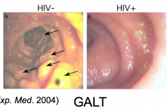 - FDC traps virus, keeps viremia low, but nodes (especially GALT - gut associated lymphoid tissue) are major sites of replication (1 billion/day)
- GALT deteriorates late in infection (destruction of lymph tissue)