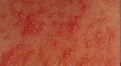 1.  Occurs in newborns on 2-3 day
2.  Multiple papules that rapidly evolve into pustules 
3.  Can become confluent
