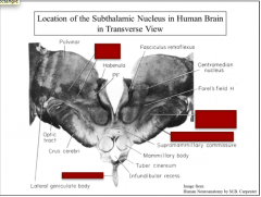 Identify the sub thalamic nucleus, cerebral peduncle, infundibulum, and VPL/VPM