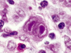 Which type of lymphomas are characterized by the presence of a tumor giant cell, the Reed-Sternberg Cell?