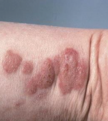 1.  Hybrid between cellulitis and urticaria
2.  Reaction to many antigens: viruses, parasites, drugs, etc.
