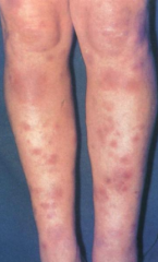 1.  Crops of bilateral deep tender nodules
2.  Overlying skin is shiny and red
3.  Acute onset arthralgia, malaise, and edema