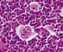 Presence of a variant of the Reed-Sternberg cells - Lacunar Cells (single multi-lobate nucleus that lies in empty space where cytoplasm tore away = lacunae)