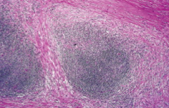 Collagen bands that divide the lymphoid tissue into nodules