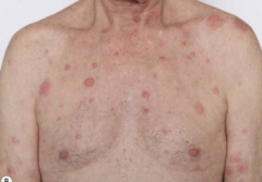 1.  Sudden onset fever
2.  Leukocytosis
3.  Tender, erythematous, well-demarcated papule and plaques
4.  Pathergy