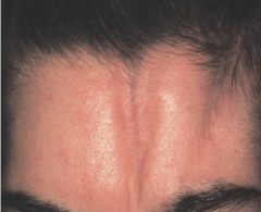 1.  Lesions that follow lines of Blaschko
2.  Parasagittal lesions on frontal scalp extend down onto forehead= En coupe de sabre