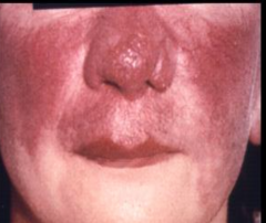 1.  Systemic granulomatous disorder
2.  Erythema nodosum
3.  Lupus vernio
4.  Anterior uveitis