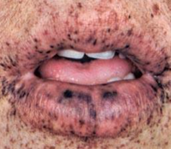 1.  AD
2.  Perioral melanotic freckles
3.  GI polyps
4.  Abdominal pain
