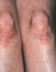 1.  Dermatitis herpetiformis--- excoriations, pruritus