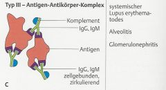 - Antikörper (IgG/IgM) richten sich gegen lösliche Antigene und bilden mit diesen Antigen-Antikörper-Komplexe (Immunkomplexe).
- Bei raschem und übermäßig starkem Anfall können die Immunkomplexe nicht mehr von Phagozyten eliminiert werden, ...