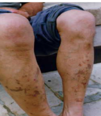 1.  Red-yellow waxy atrophic plaques
2.  Due to microangiopathy